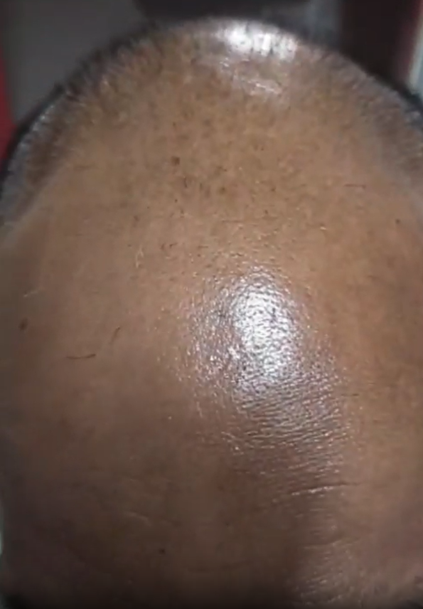 Effective hair regrowth